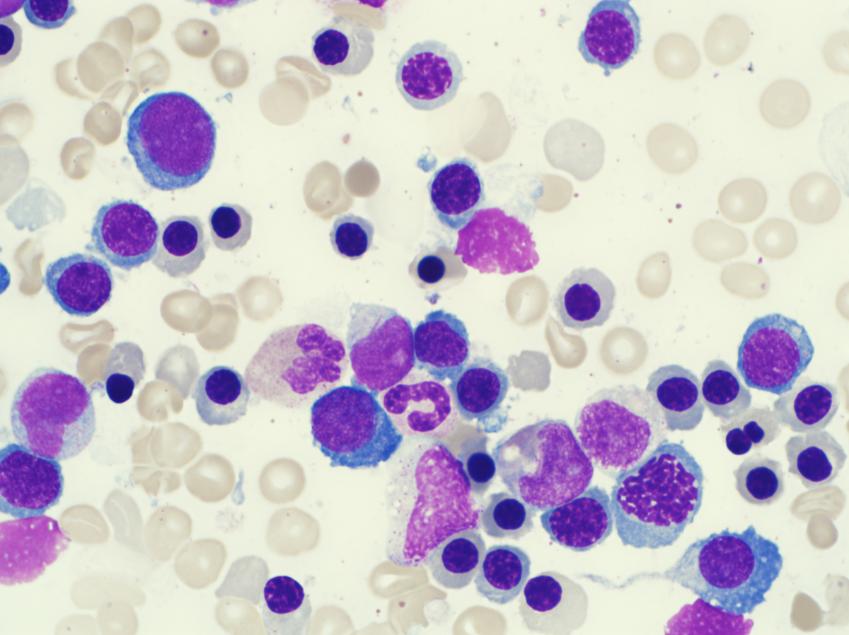 Bone marrow aspirate with blasts showing Auer rods and marked increase in the erythroid precursors.